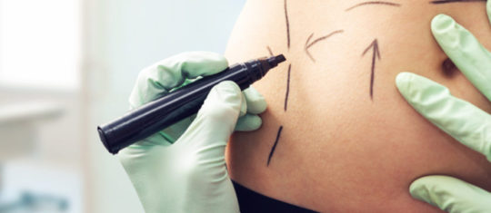 lipoaspiration